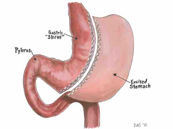 GASTRIC SLEEVE SURGERY – ALL YOU NEED TO KNOW – Ekachaihospital