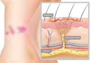 webmd_illustration_of_shingles_virus
