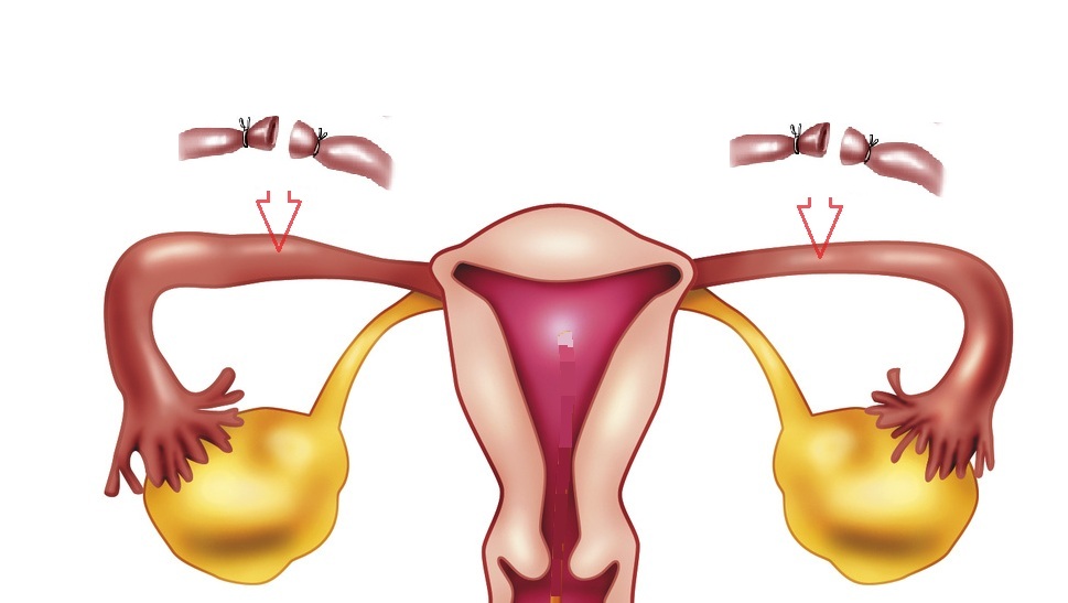 artificial insemination