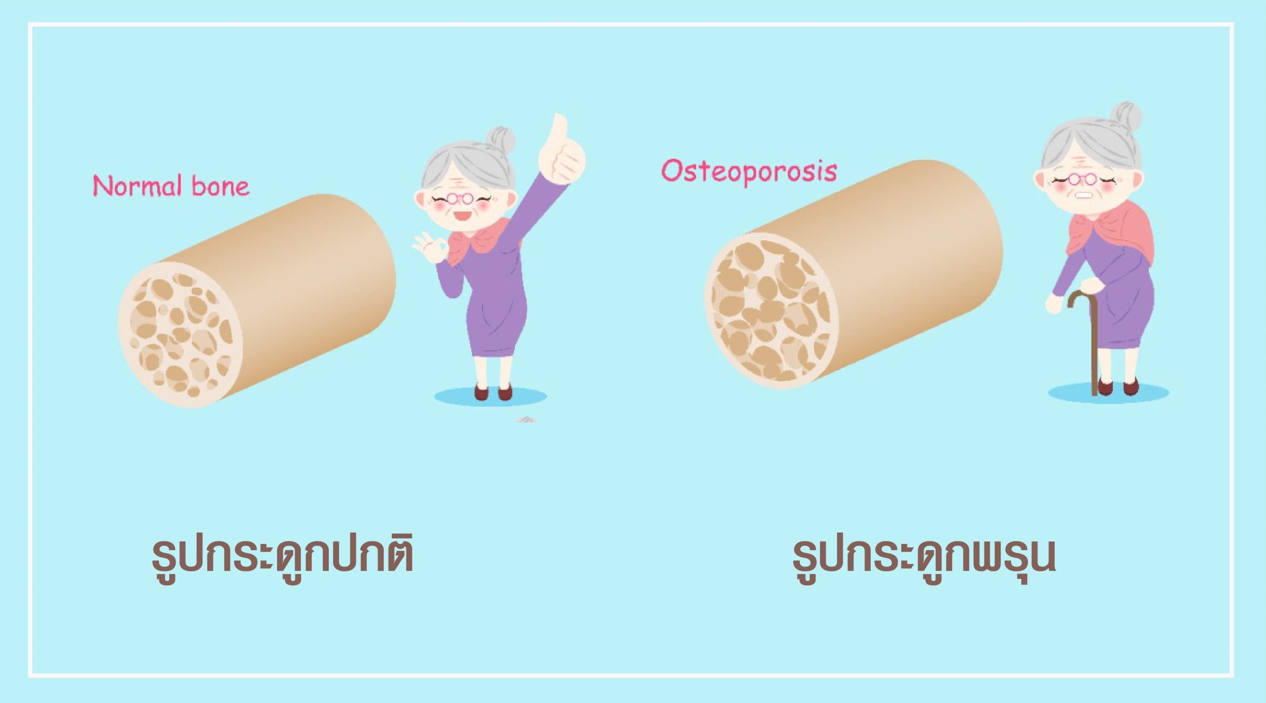 โรคกระดูกพรุน